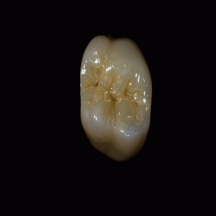 images/zirconiacrown/Polished-Occlusal-Full-Contour-GatorZ-Crown.gif